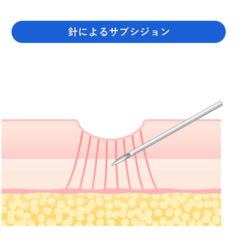 針によるサブシジョン