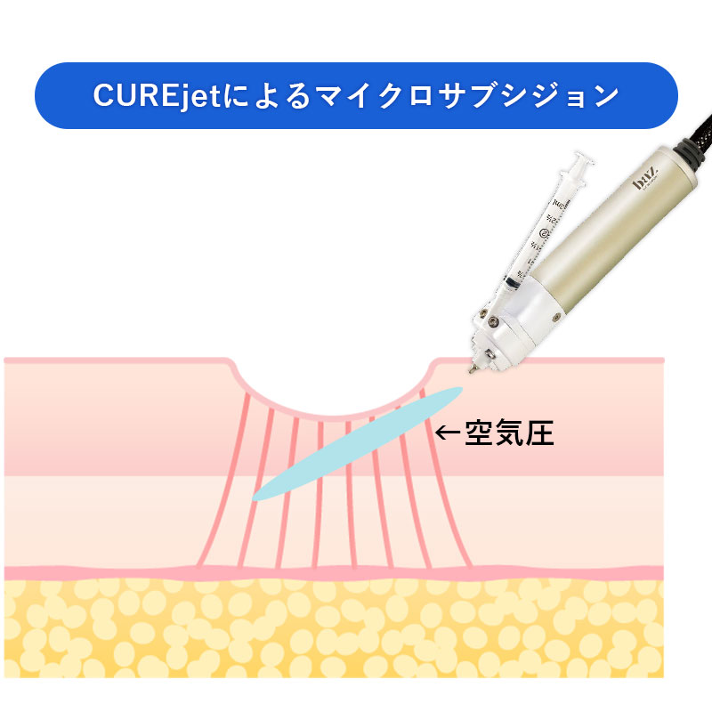 キュアジェットによるサブシジョン