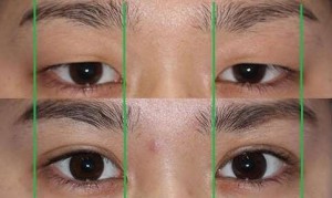 眼瞼下垂修正法