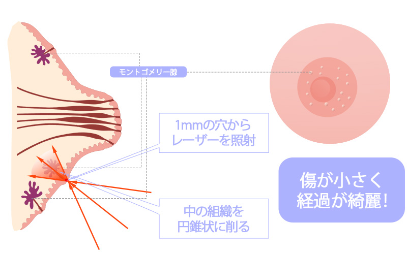 モントゴメリー腺除去　プチレーザー治療