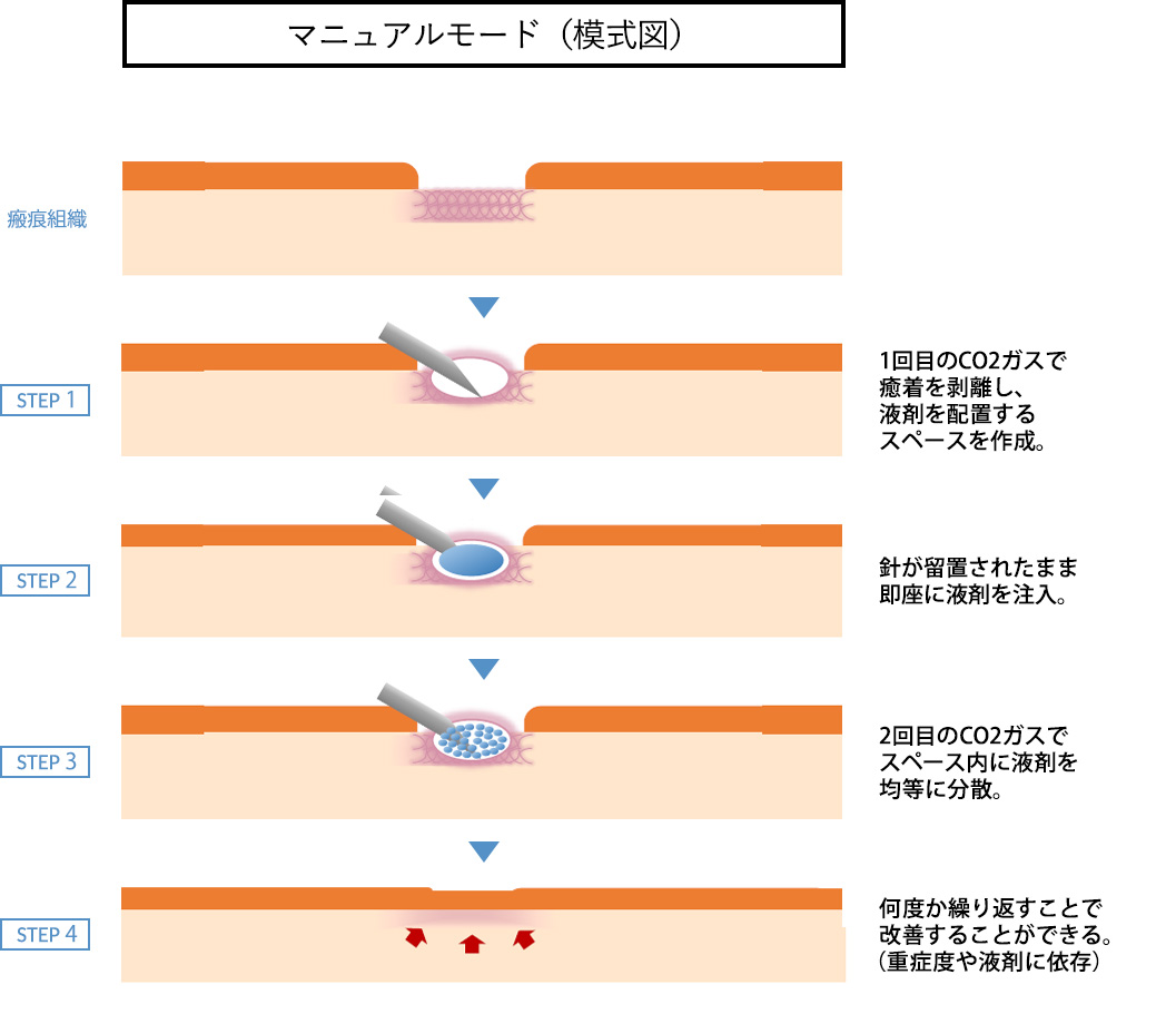 マニュアルインジェクション（模式図）