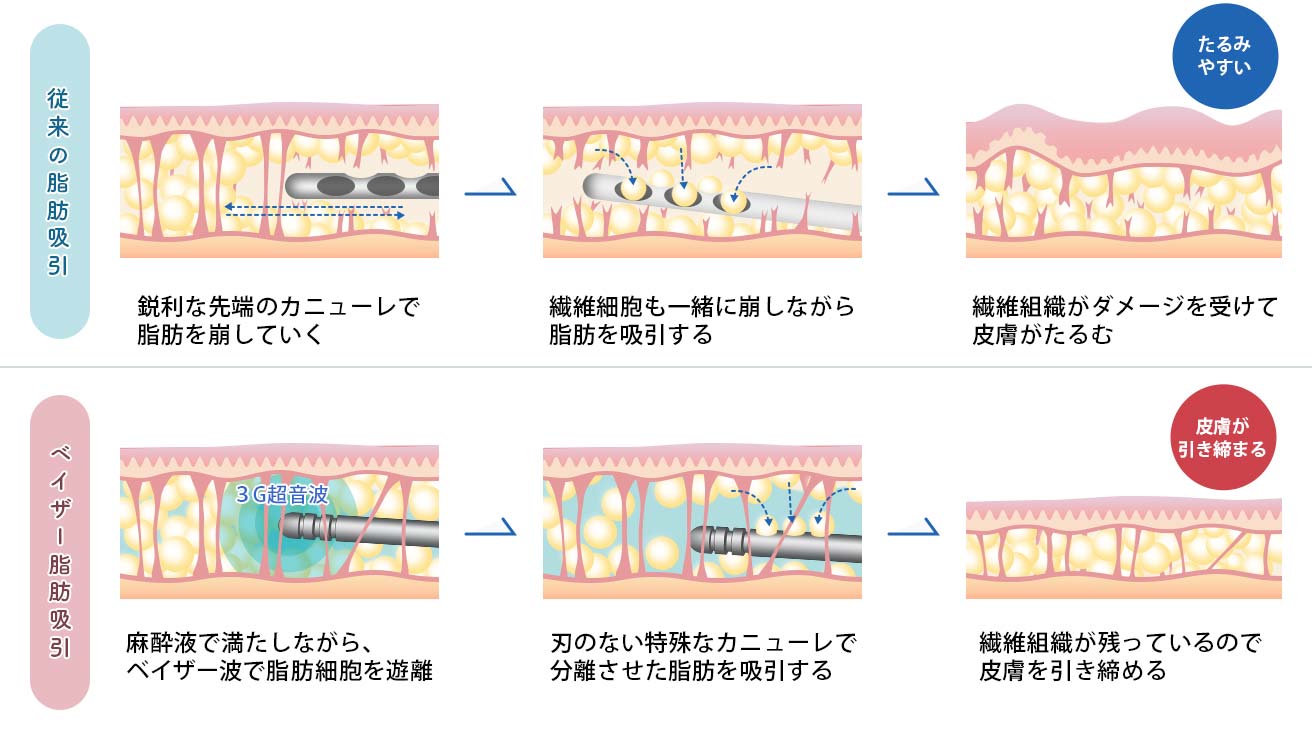 ベイザー脂肪吸引は従来の脂肪吸引と何が違うの?
