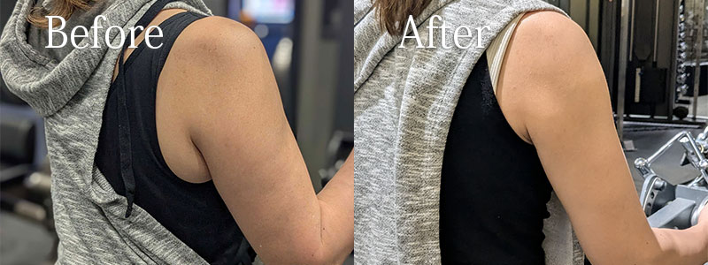 ベイザー脂肪吸引を体験しました