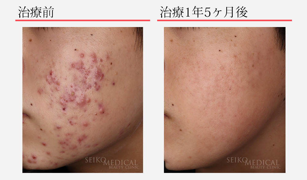 ニキビ特別学生治療15