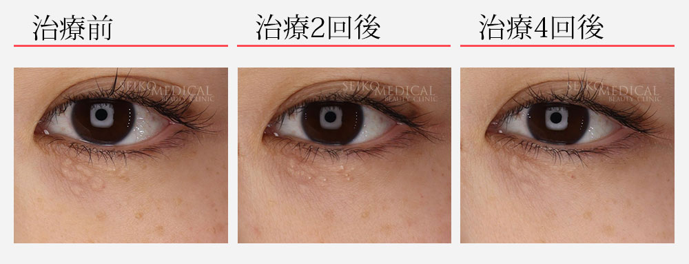 アグネス　汗管腫