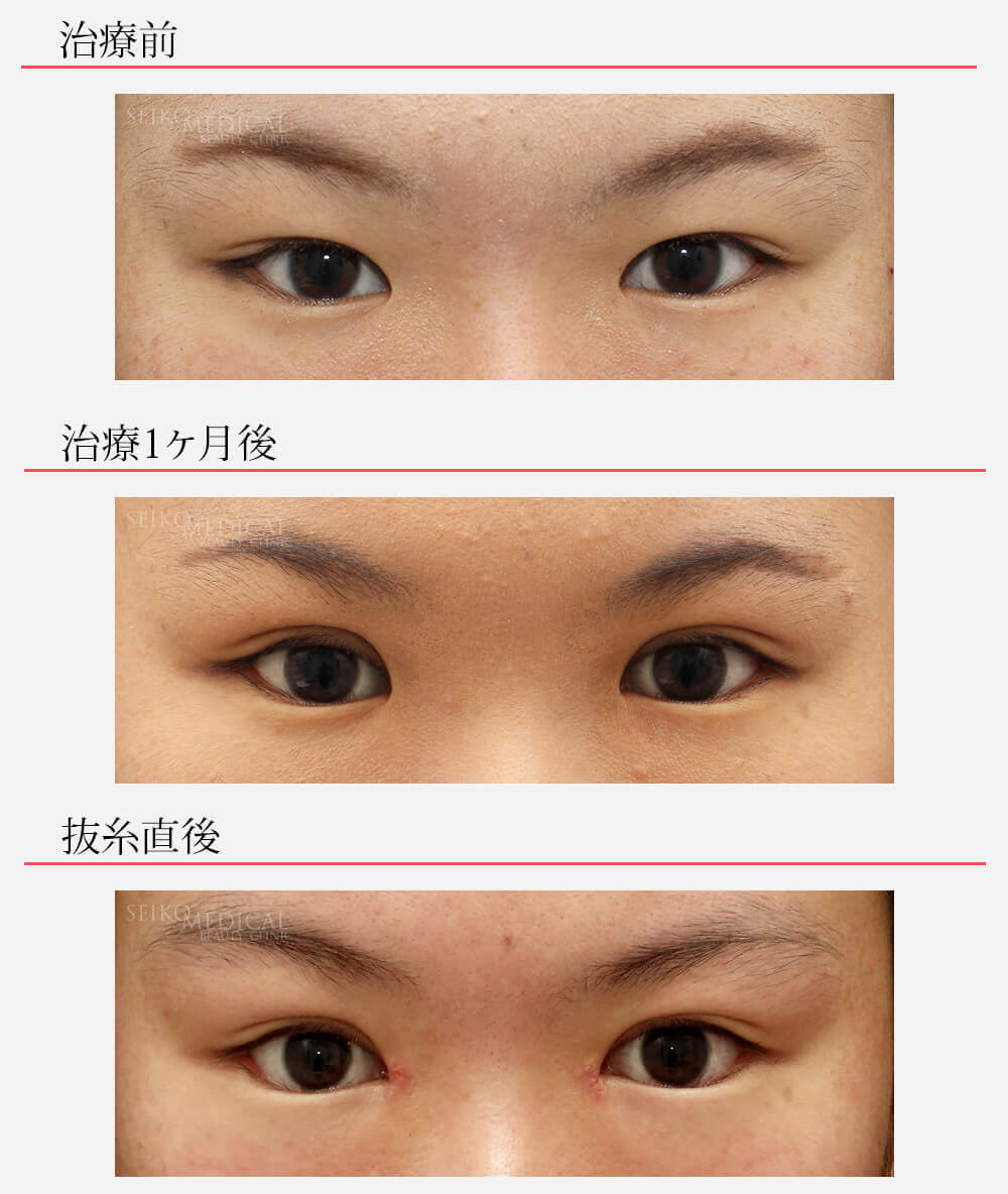 上眼瞼脂肪除去 眼瞼下垂修正法 目頭切開 切らないたれ目形成術