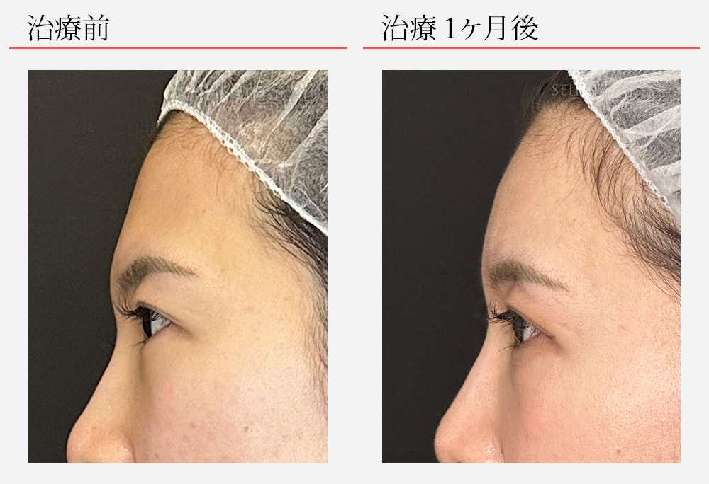 額ヒアルロン酸　症例19