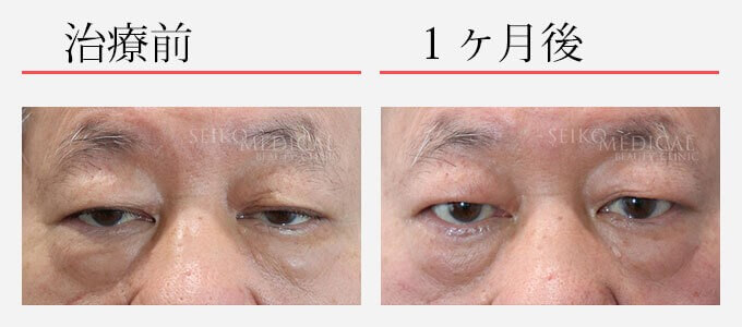 眼瞼下垂症の治療経過写真（1ヶ月後）