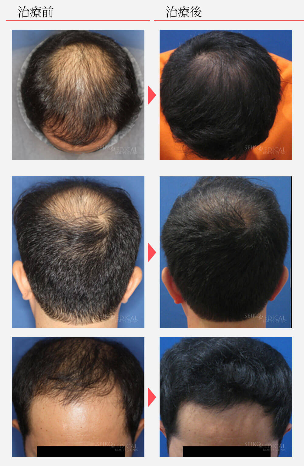 毛髪再生療法 ヘアリバイバル ロゲインフォーム