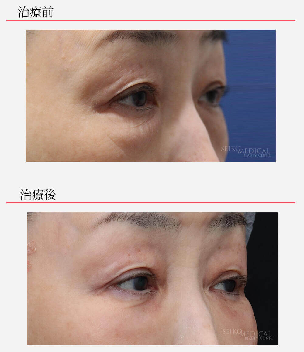 当院オリジナル 下眼瞼脂肪除去 脂肪注入 目の下皮膚切除