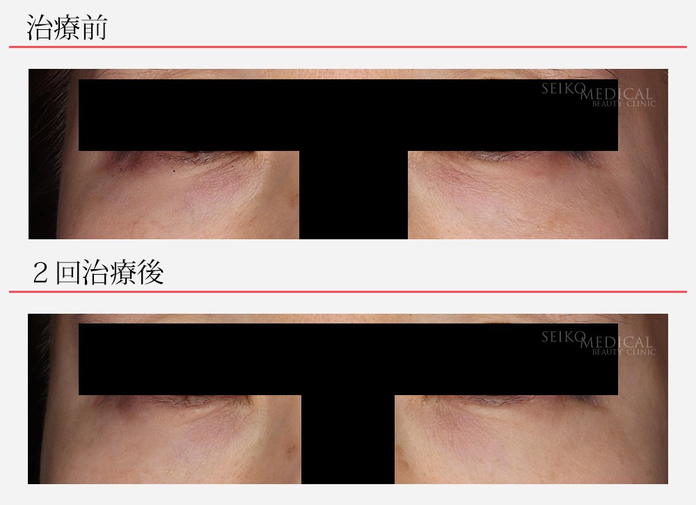プルリアル 症例写真
