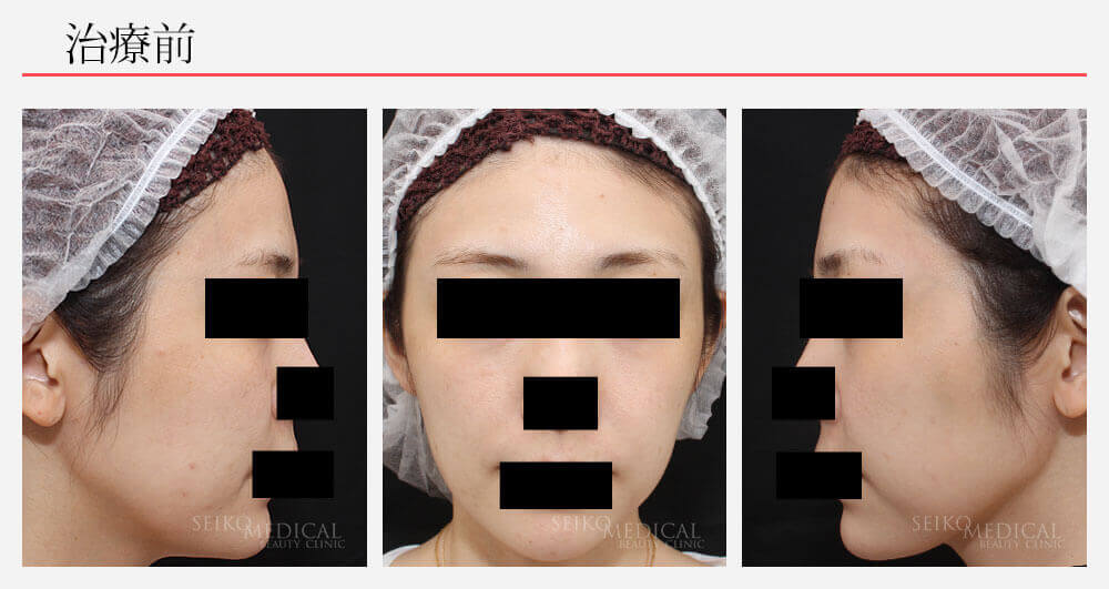 糸によるリフトと額（おでこ）のヒアルロン酸注入による顔を立体的に美しくする治療