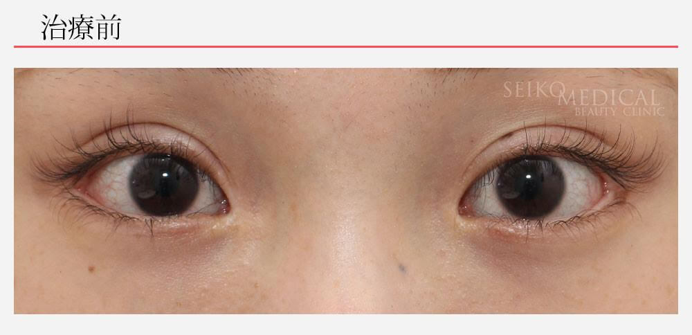 片目の垂れ目形成術の症例解説（他院修正）