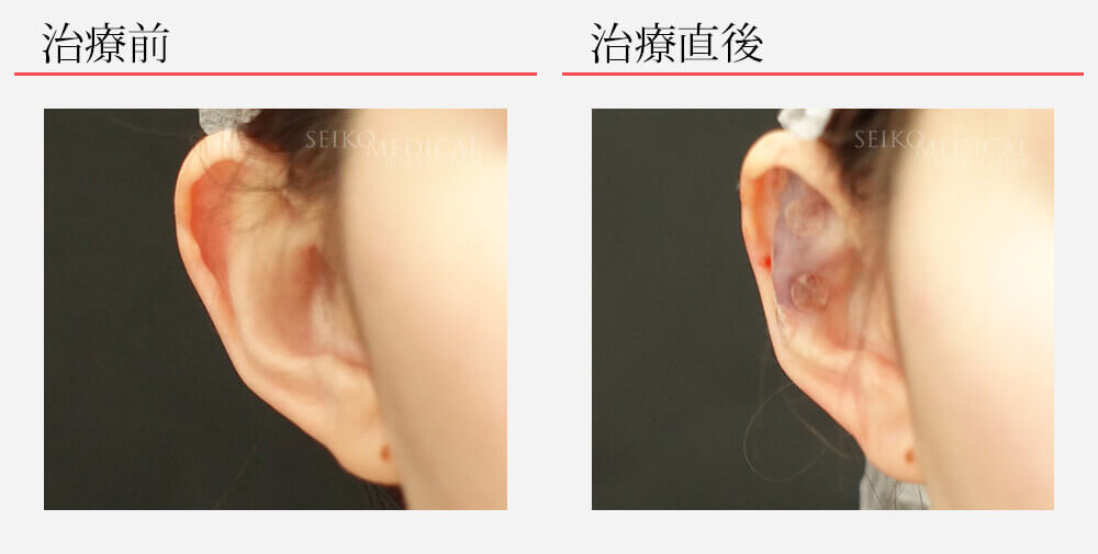 【立ち耳治療】片耳だけを皮膚を切らない方法で行った症例解説