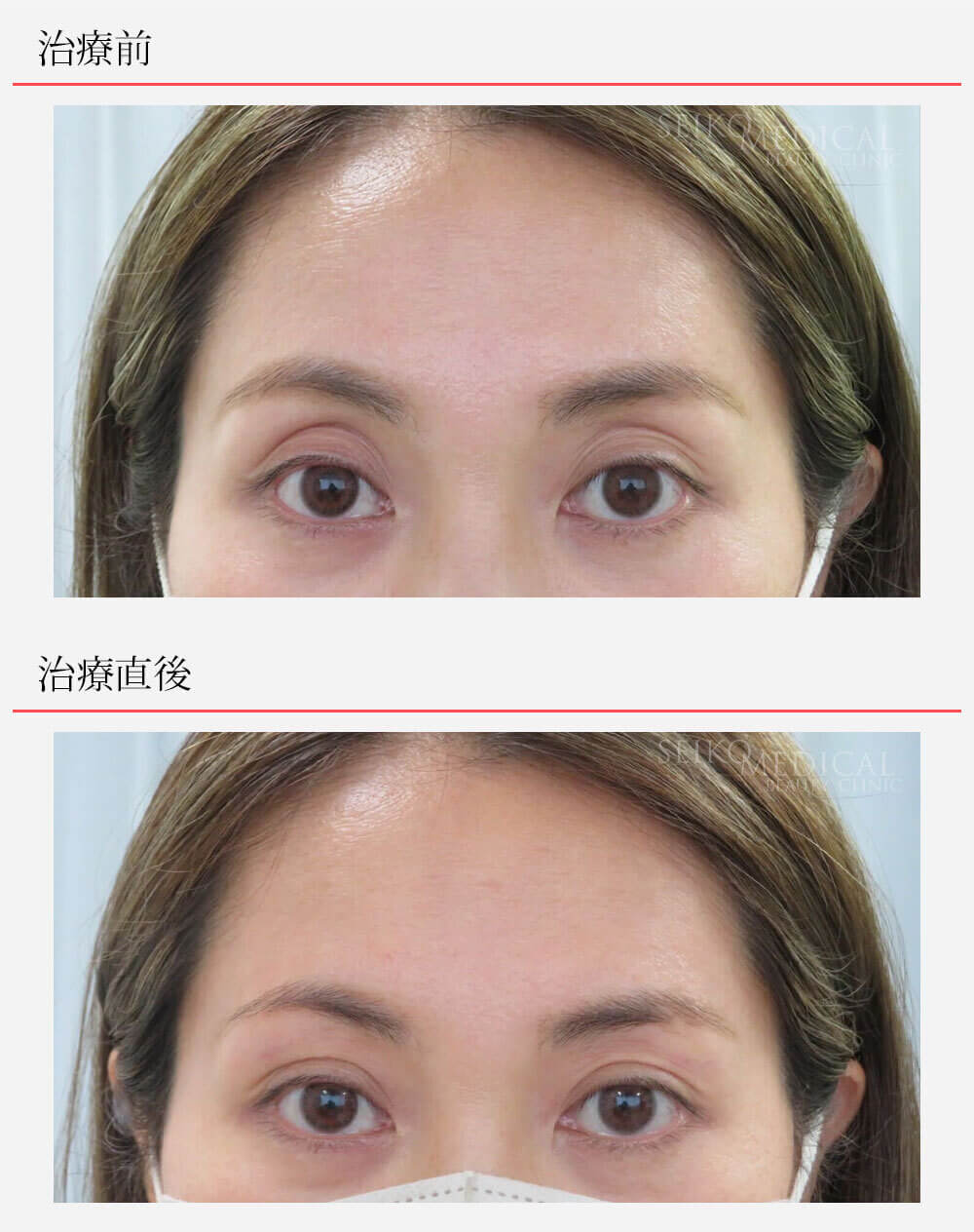 くぼみ目への凸凹しないヒアルロン酸注入、治療直後の経過