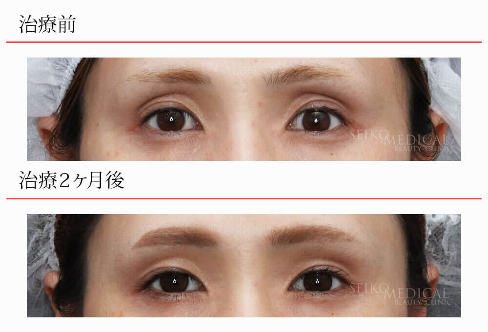 強いくぼみ目の方へのヒアルロン酸注入、治療２ヶ月後の経過