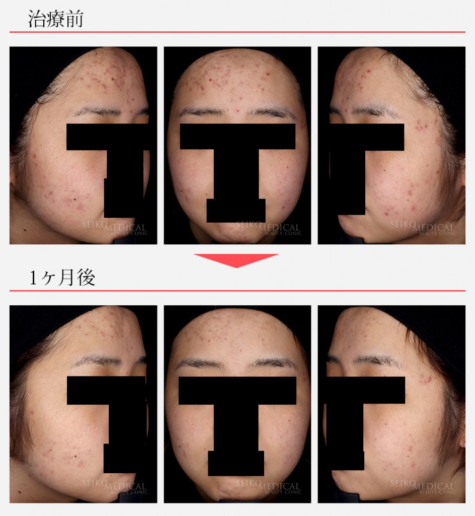 ゼオスキンヘルスを1ヶ月使用後の症例写真をまとめてみました | ゼオ