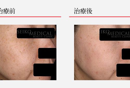 いちご ゼオスキン 新品 6点セット いちご ゼオスキン 新品 6点セット いちご ゼオスキン 新品 6点セット