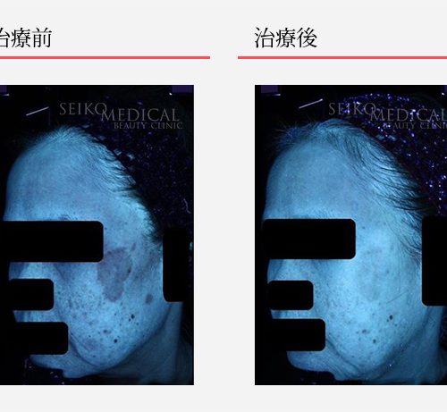 60代女性 1ヶ月でこんなに変わりました！ | ゼオスキンヘルス