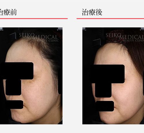 40代女性 約4ヵ月後経過の症例 | ゼオスキンヘルス｜セイコ