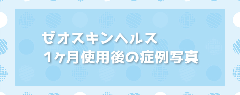 ゼオスキンヘルスを1ヶ月使用後の症例写真をまとめてみました | ゼオ