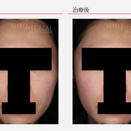 皮剥けた ゼオスキン~治療~ トレチノイン0.1% ver 経過レポ ◎ - きれいな
